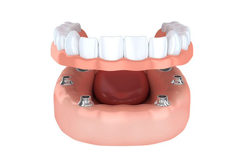 implantes dentales en Santa Cruz de la Palma, implantes dentales en Los Llanos