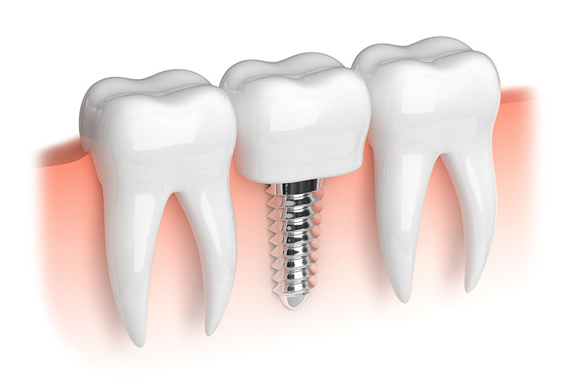 implantes dentales en Santa Cruz de la Palma, implantes dentales en Los Llanos